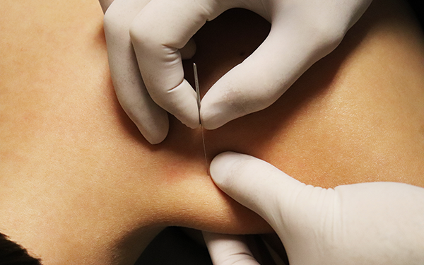 Trigger Point Dry Needling